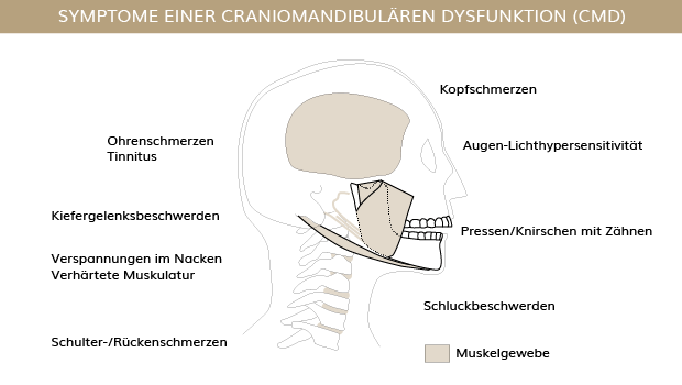 CMD-Symptome, Zahnärzte Ebmatingen, Dr. Brietze & Dr. Gabriel 