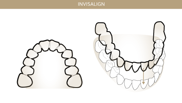 Invisalign, Zahnärzte Ebmatingen, Dr. Brietze & Dr. Gabriel 