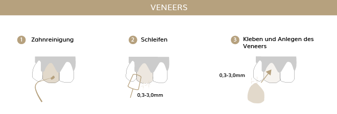 Veneers, Zahnärzte Ebmatingen, Dr. Brietze & Dr. Gabriel 