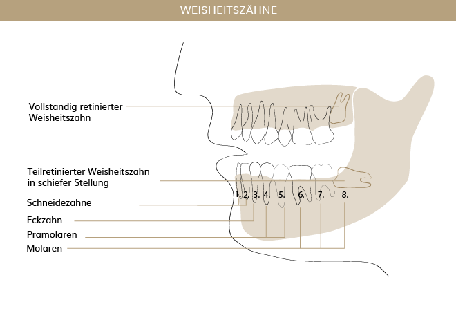 Weisheitszähne, Zahnärzte Ebmatingen, Dr. Brietze & Dr. Gabriel 