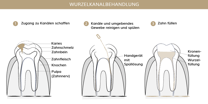 Wurzelkanalbehandlung, Zahnärzte Ebmatingen, Dr. Brietze & Dr. Gabriel 