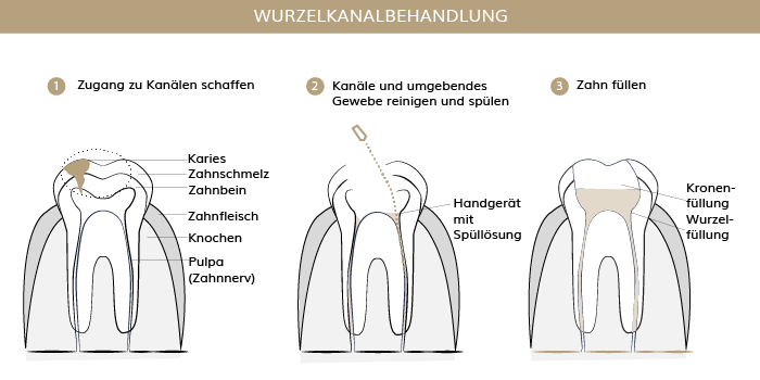 Wurzelkanalbehandlung, Zahnärzte Ebmatingen, Dr. Brietze & Dr. Gabriel