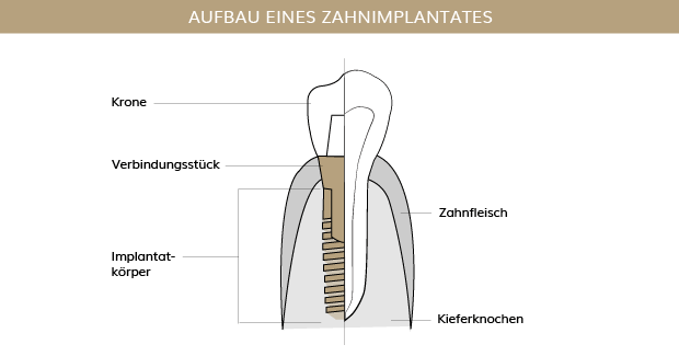 Zahnimplantate, Zahnärzte Ebmatingen, Dr. Brietze & Dr. Gabriel 